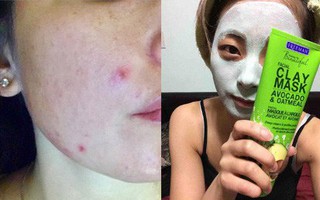 Công cuộc trị mụn tận gốc sẽ đơn giản, nhanh gọn hơn nhiều với những sản phẩm đặc trị giá không quá 350 ngàn