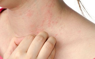 Bệnh chàm với triệu chứng đỏ, mẩn ngứa trên da có thể do 6 nguyên nhân này gây ra nhưng lại bị bạn vô tình bỏ qua