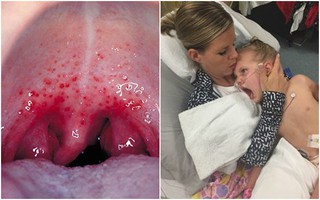 Con gái kêu đau họng nên mẹ đưa đến gặp bác sĩ và cho uống thuốc cảm cúm thông thường, 6 tháng sau cô bé qua đời