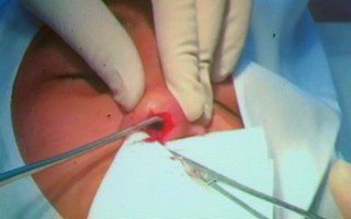 Cô gái 28 tuổi suýt hỏng mũi, biến dạng mặt nặng nề sau khi tiêm chất làm đầy trôi nổi