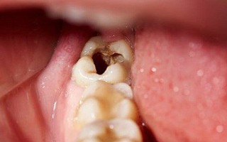 Răng số 8 - răng khôn mọc... dại: Khi nào cần nhổ, nhổ có nguy hiểm không?