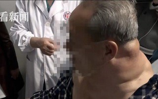 Mỗi ngày uống 1 lít rượu trong 25 năm, người đàn ông Trung Quốc ‘biến dạng’