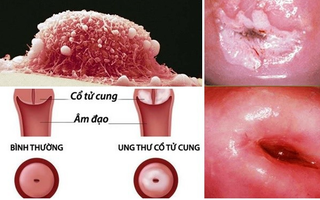 Thủ phạm khiến 7 phụ nữ Việt tử vong mỗi ngày, chị em cần làm ngay điều này để phòng tránh
