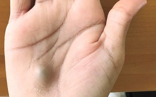Bàn tay sưng phồng bất thường, người đàn ông tá hỏa khi biết mình mắc bệnh nhiễm trùng gây tử vong sau khi đến nha sĩ khám răng