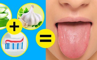 Nhận biết bệnh qua từng vùng lưỡi màu trắng và 5 cách đơn giản giúp lưỡi khỏe mạnh, hết vi khuẩn