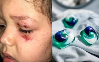 Người mẹ lên tiếng cảnh báo sau khi viên nước giặt phát nổ khiến con gái 4 tuổi bị bỏng và chấn thương vùng mắt
