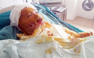Hoàn cảnh bi đát của cô gái trẻ lao vào cứu bạn trong vụ bị người tình tẩm xăng thiêu sống
