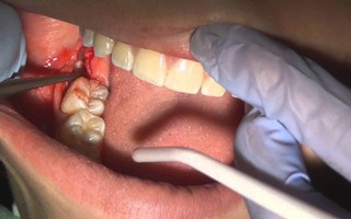 Có thể tử vong vì nhổ một chiếc răng số 8 hay không?