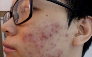 Chỉ tốn 10 nghìn đồng, chàng trai bị mụn mủ lâu năm bỗng trắng mịn bất ngờ