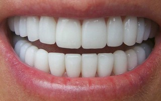 Bác sĩ BV Răng hàm mặt Trung ương chỉ rõ 3 biến chứng đáng sợ của răng sứ thẩm mỹ