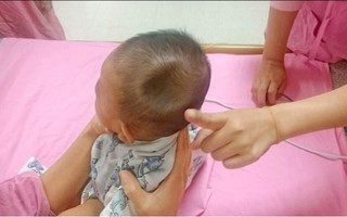 Chỉ vì sơ suất của bố mẹ khi đi xe, bé trai 4 tháng tuổi bị lõm sọ não như quả táo cắn dở