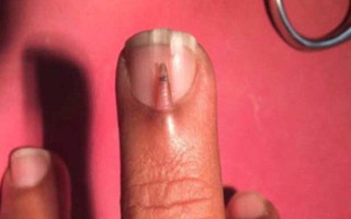 Phát hiện điều “kỳ quái” trên móng tay, người đàn ông mất 4 tháng ròng rã mới tìm được lời giải thích