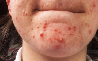 Cô gái 24 tuổi ở Anh phải nhập viện vì viêm tụy do sử dụng sai thuốc trị mụn