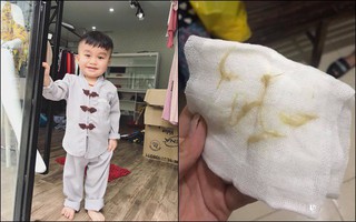Chơi với giấy ăn, bé 21 tháng tuổi bị suy hô hấp và bác sĩ gắp được vật này trong phổi