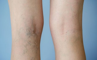 Bạn có thể kiểm soát tình trạng suy giãn tĩnh mạch nhờ những phương pháp đơn giản này