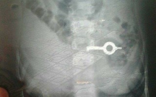 Mẹ bàng hoàng phát hiện con 5 tuổi nuốt trọn chiếc chìa khóa vào bụng