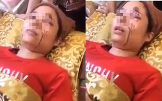 Vụ cô gái tố bị tạt axit ở Chương Mỹ, Hà Nội: Chính cô gái là người tạt a-xít người tình