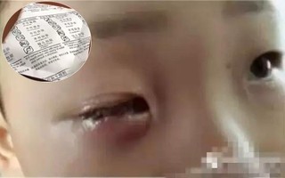 Bé 8 tuổi bị mù 1 mắt vĩnh viễn chỉ vì chiếc túi hút ẩm nhỏ xíu