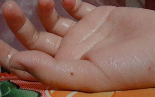 Nỗi khổ chỉ những người bị ra mồ hôi tay chân mới hiểu: Trời càng nóng, càng ướt nhẹp!