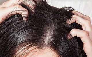 Xử lý khi bị nấm da đầu, tránh khó chịu, ngứa ngáy, mất tự tin vào mùa hè