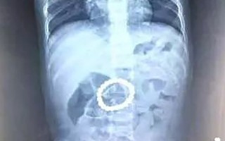 Hình ảnh chụp X-quang dạ dày của bé trai 14 tháng tuổi và lời cảnh tỉnh các bố mẹ về món đồ chơi mà trẻ nhỏ rất thích