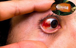 Sơ cứu đúng cách khi bị bọ xít “đái” vào mắt, tránh biến chứng nguy cơ mù lòa