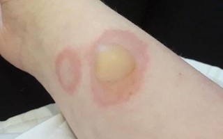 Mẹ hoảng sợ khi nhìn thấy vết rộp trên tay con gái, càng kinh hoàng hơn khi biết đó là một trào lưu phổ biến trong trường học
