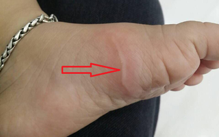 Về quê chơi dịp hè, bố kinh hãi phát hiện con gái 5 tuổi bị giun xâm nhập cơ thể, bò lúc nhúc dưới da