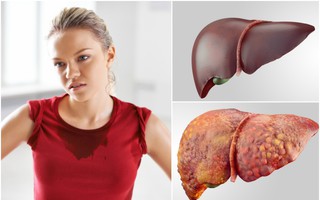 Bác sĩ nghiên cứu lâm sàng về gan chỉ cho bạn 5 yếu tố hàng đầu tăng nguy cơ phát triển bệnh gan