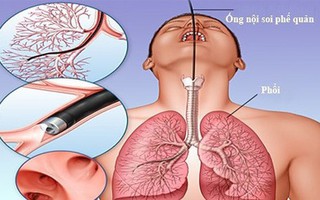 BV Bạch Mai thông tin về bệnh nhân tử vong sau khi nội soi phế quản