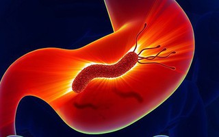 Những nguyên nhân hàng đầu gây ung thư dạ dày mà nhiều người bỏ qua, đặc biệt là số 2
