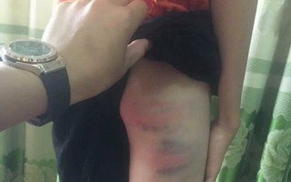 Vụ mẹ kế nghi bạo hành cháu bé 12 tuổi đến nhập viện ở Nghệ An: Công an vào cuộc, đang lấy lời khai hai bên liên quan