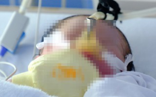 Thai nhi văng khỏi bụng mẹ ở Bình Dương tiên lượng khó qua khỏi