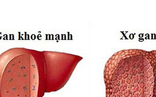 Bỏ túi danh sách thực phẩm ngăn ngừa xơ gan tốt nhất