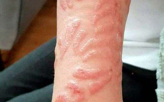 Hai đứa trẻ đau đớn khi tay, lưng sưng tấy do vẽ henna trong chuyến du lịch và lời cảnh báo nhiều phụ huynh bỏ qua