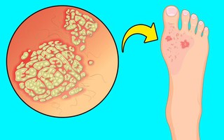 Thêm 5 dấu hiệu kì cục ở chân cảnh báo những rối loạn về sức khỏe không thể coi thường