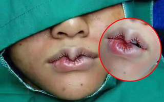 Đôi môi "trái tim yêu dấu" nổi tiếng nhất MXH đêm qua, chủ spa hạnh phúc khoe thành quả, dân mạng ném đá "chẳng khác mỏ chim"