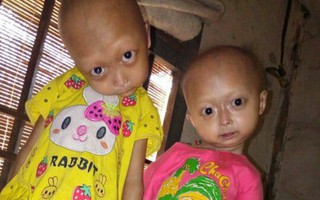 Tuyên Quang: 2 chị em gái mắc bệnh lạ khiến đầu, cổ bị nghẹo tựa "người ngoài hành tinh" khiến ai nhìn cũng xót xa