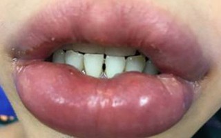 Cô gái trẻ bị biến dạng mắt, môi sau khi tiêm filler tại một thẩm mỹ viện ở Hà Nội