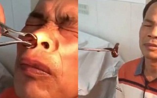 Trung Quốc: Ông chú đi khám mũi đau lâu ngày không khỏi, bác sĩ lôi ra nguyên con đỉa lớn đang 'ở nhờ' bên trong