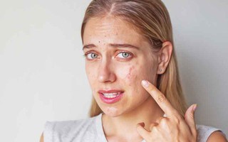 Mẹo trị sẹo mụn an toàn mà không hề tốn kém, không chỉ vết thâm biến mất, da mặt cũng mịn màng sáng sủa hẳn ra
