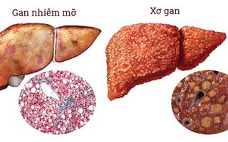 'Chất độc' gây hại cho gan nhiều người Việt lạm dụng hàng ngày