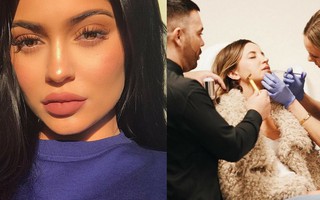 Nếu băn khoăn sau khi rút hết filler, đôi môi có trở lại trạng thái tự nhiên không thì đây là câu trả lời dành cho bạn