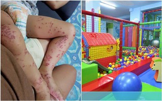Bé trai bị lây nhiễm bệnh chân tay miệng từ nơi mà trẻ nào cũng ghé đến hàng tuần