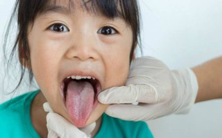Nếu con bạn có hiện tượng này, có thể bé đã mắc phải bệnh viêm lưỡi bản đồ