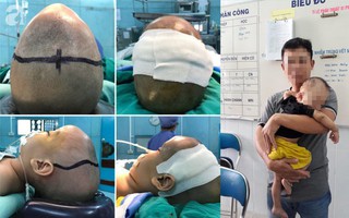 Cha mẹ nghẹn ngào khi con trai được bác sĩ giải thoát khỏi căn bệnh hiếm gặp với đầu to như "người ngoài hành tinh"
