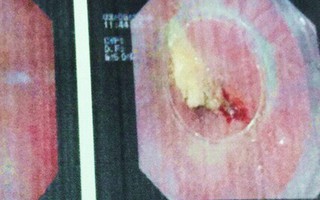 TP.HCM: Mắng con trong lúc ăn phở gà, mẹ bị hóc xương thủng thực quản