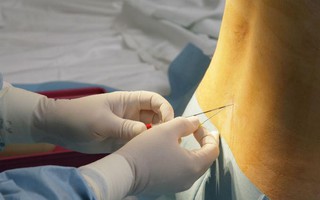 Tất tật những điều các mẹ cần biết về mũi gây tê ngoài màng cứng - phương pháp giảm đau khi sinh nở