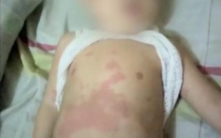 Mẹ dùng mỹ phẩm trắng da khiến con bị dị ứng nghiêm trọng