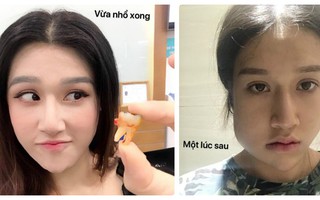 Cô gái Hà Nội đăng ảnh sưng lệch mặt vì nhổ răng khôn, dân mạng chẳng an ủi vì bận... khen "chủ top xinh thế"